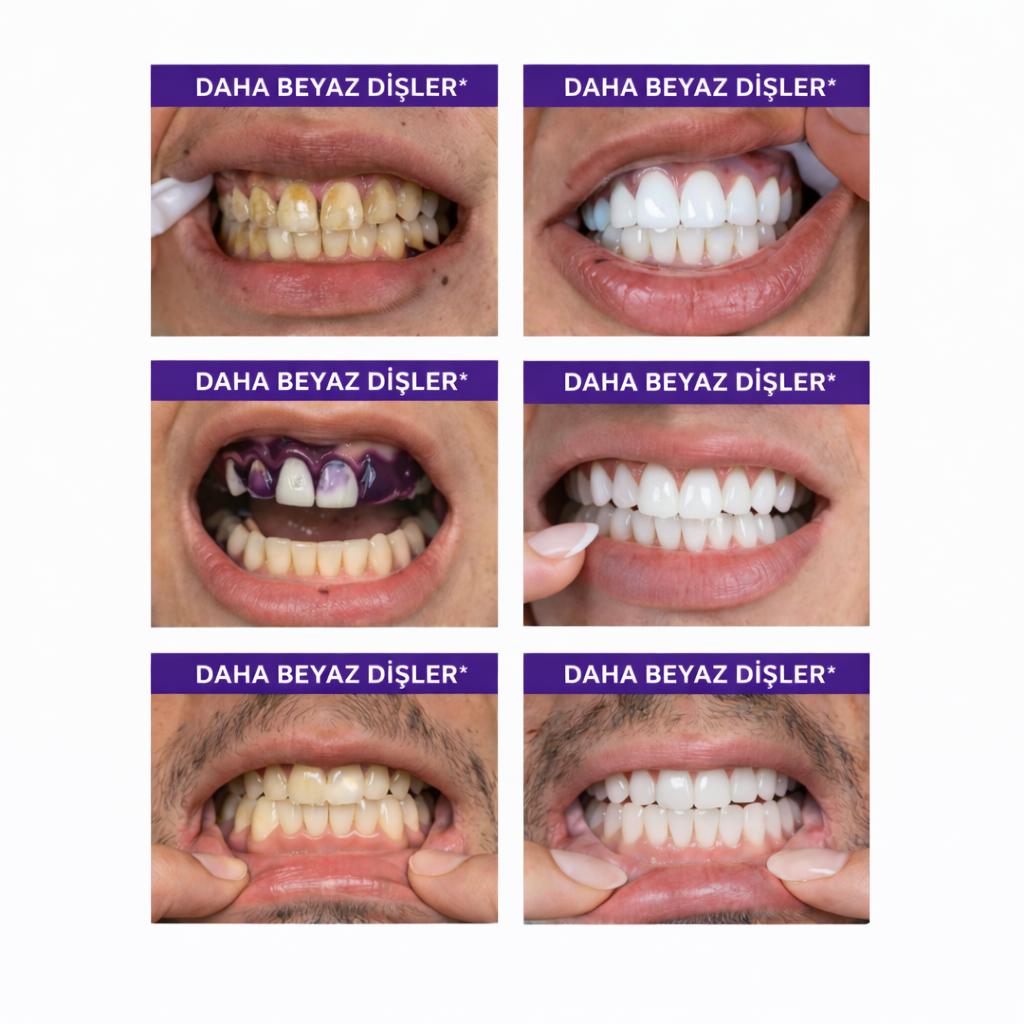 Resmile V34 kullanım öncesi ve sonrası daha beyaz dişler