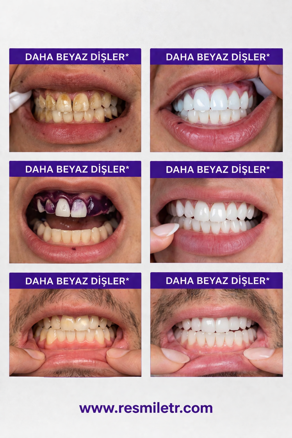 Re Smile V34 Diş Bantları
