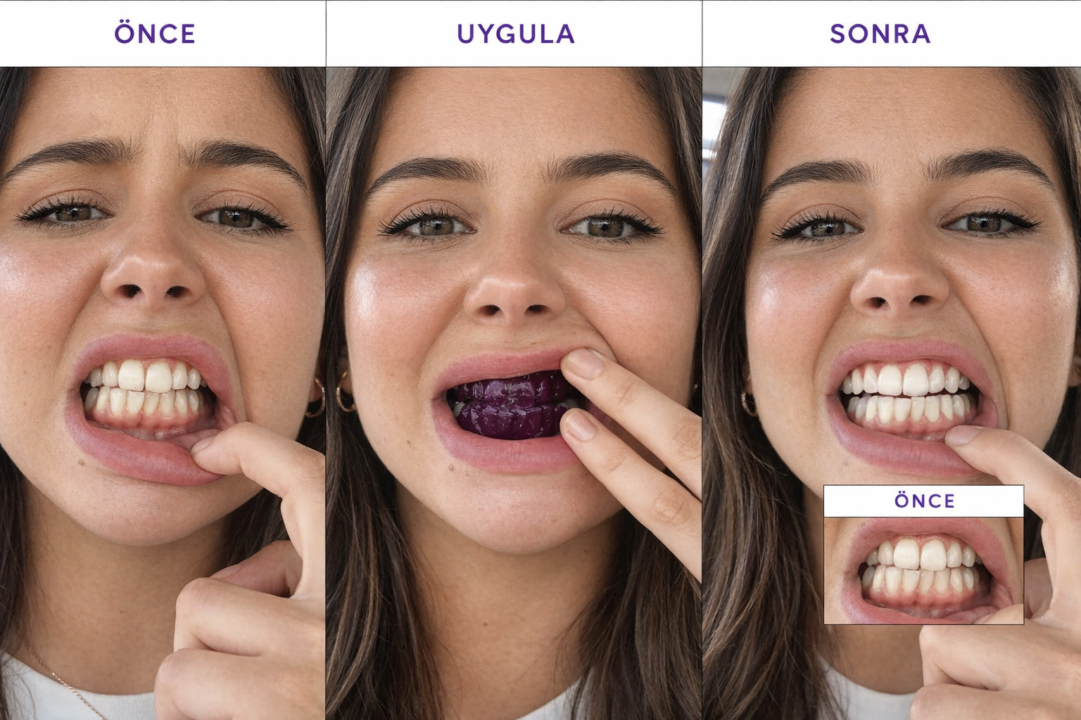 Re Smile V34 Diş Bantları